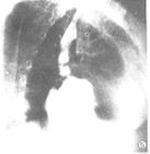 消化道疝 消化道疝