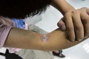 毒隱翅蟲皮炎 毒隱翅蟲皮炎