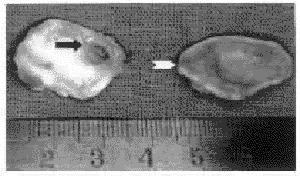 （圖）耳廓化膿性軟骨膜炎