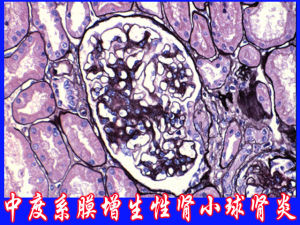 膜增生性腎小球腎炎