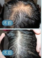 假性斑禿 假性斑禿