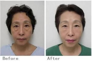 複合彩光嫩膚 複合彩光嫩膚