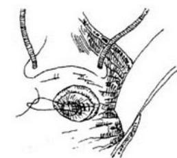 帶血管蒂腸漿肌層片修補術 帶血管蒂腸漿肌層片修補術