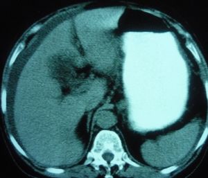 左腎囊腫 左腎囊腫