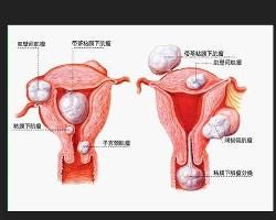更年期功血 更年期功血