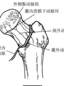 股骨粗隆間骨折