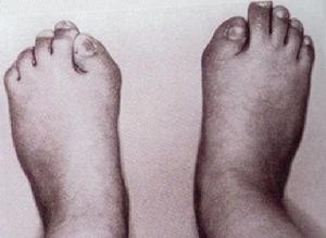 進行性骨化性肌炎