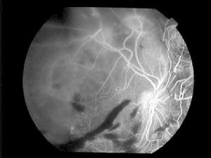 腎病性視網膜病變