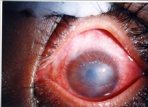 （圖）後發性白內障