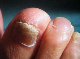 腳趾甲內長 腳趾甲內長