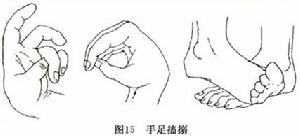 毒性瀰漫性甲狀腺腫