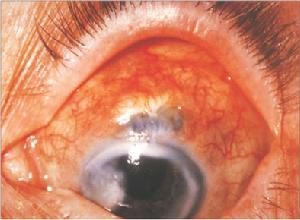 白膜侵睛 白膜侵睛