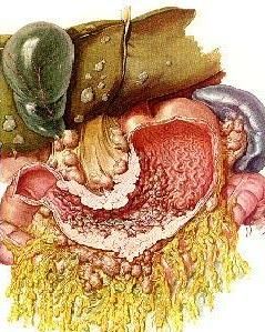 腹膜轉移癌 腹膜轉移癌