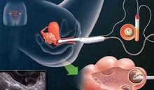 DZ6000精選促卵技術操作優勢