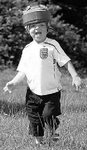 阿佩爾氏綜合症 阿佩爾氏綜合症