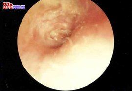 慢性中耳炎 慢性中耳炎