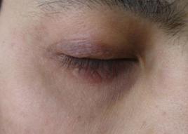 眼瞼神經性皮炎 眼瞼神經性皮炎