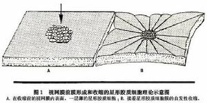 特發性黃斑部前膜