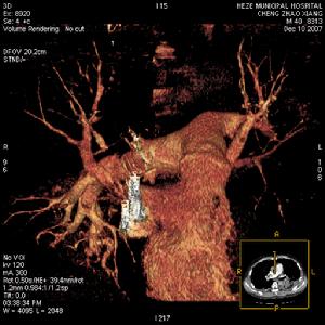 脂肪栓塞綜合徵
