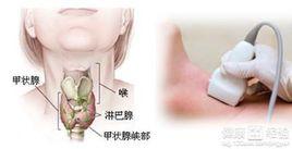 結核性甲狀腺炎 結核性甲狀腺炎