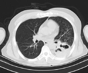 圖1. 左肺下葉空洞合併咯血