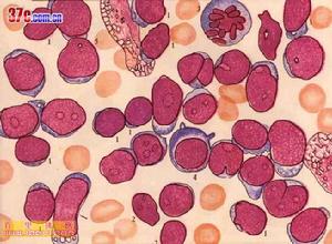 急性淋巴細胞白血病 骨髓象