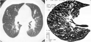 呼吸性細支氣管炎相關間質性肺病 呼吸性細支氣管炎相關間質性肺病
