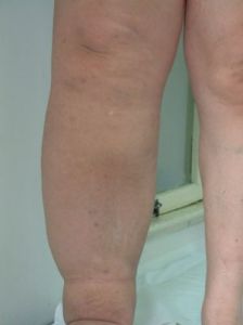 下肢淋巴水腫 下肢淋巴水腫