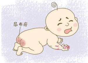 新生兒尿布疹