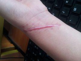 外傷疤痕 外傷疤痕