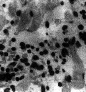 甲狀腺相關眼病