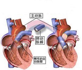 法洛氏三聯症 法洛氏三聯症