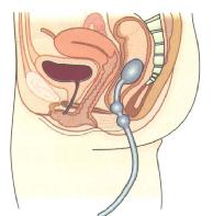先天性直腸肛門發育畸形