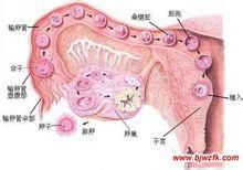 多卵巢囊腫