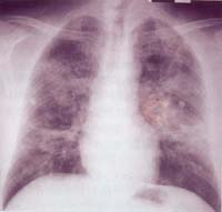 克雷伯桿菌肺炎 克雷伯桿菌肺炎