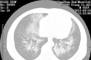 PCP型肺炎 PCP型肺炎