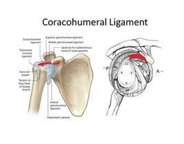 喙肱韌帶 喙肱韌帶