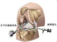 膝關節韌帶損傷 膝關節韌帶損傷