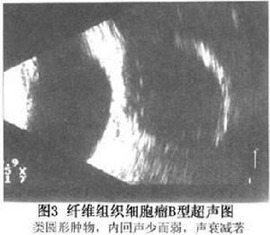 眶內纖維組織細胞瘤