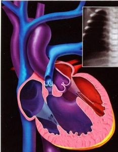 老年人鈣化性瓣膜病 老年人鈣化性瓣膜病