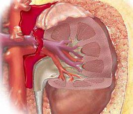 無症狀細菌尿 無症狀細菌尿