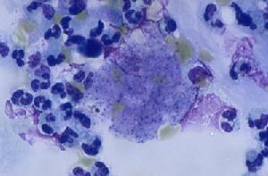 脫屑性間質肺炎