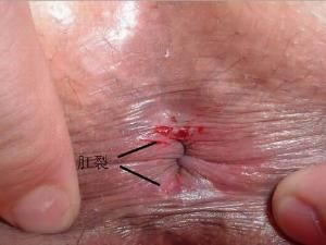 急性肛裂 急性肛裂