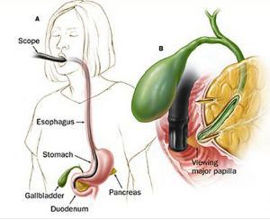 壺腹周圍癌 壺腹周圍癌