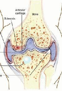 風濕關節炎 風濕關節炎