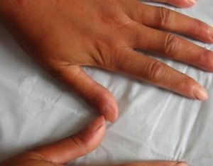 瀰漫性結締組織病 瀰漫性結締組織病