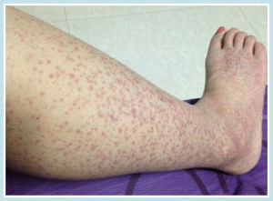 單純性紫癜 單純性紫癜