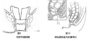先天性巨結腸症