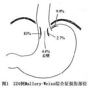 賁門黏膜撕裂綜合徵