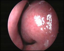 鼻端肥大 鼻端肥大